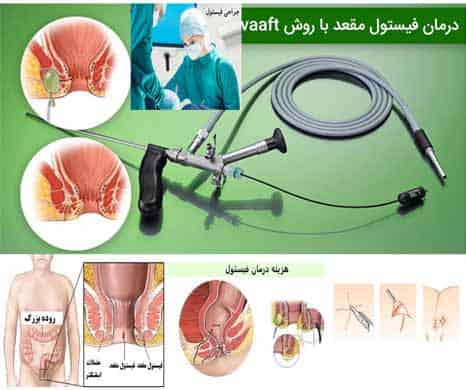 ,فیستول شقاق یا فیشر مقعدی,