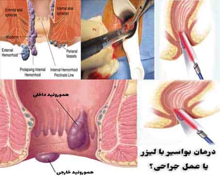 ,جراحی لیزر هموروئید,جراحی بواسیر,